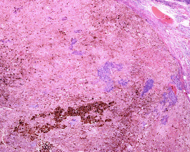 Low magnification micrograph showing a metastasis of a malignant melanoma invading a lymph node. The normal lymphoid tissue has almost completely disappeared and has been replaced by malignant melanoma pigmented and non-pigmented cells. - 写真・画像