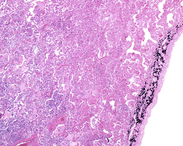 Периферія легень людини, уражених гострою пневмонією. Набряк альвеолів зайнятий рідиною набряку, яка містить гострі запальні інфільтрати (з переважанням нейтрофільних гранулоцитів). Праворуч плевра показує багато вуглець-ло
 - Фото, зображення