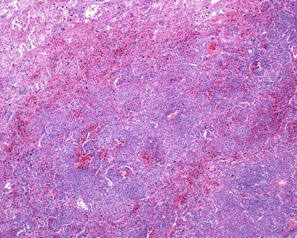 Людська легеня, уражена гострою пневмонією. Люмен альвеолів зайнятий рідиною набряку, яка містить гострі запальні інфільтрати (з переважанням нейтрофільних гранулоцитів
). - Фото, зображення