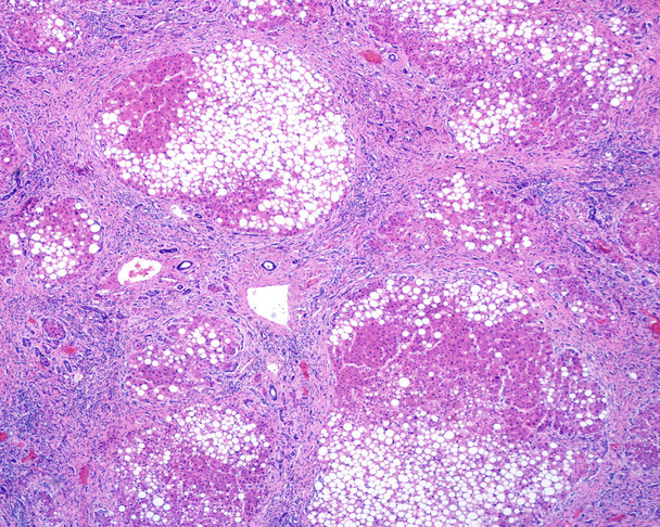 Ihmisen maksa. Kirroosi. Alhainen suurennusmikrograafi, jossa näkyy hepatosyyttien regeneroivia kyhmyjä (laajalla rasvan muutoksella), erotettuna kuituisella septalla, jossa on kroonisia tulehdusinfiltraatteja. Maksakirroosi johtuu vakavista vaurioista - Valokuva, kuva