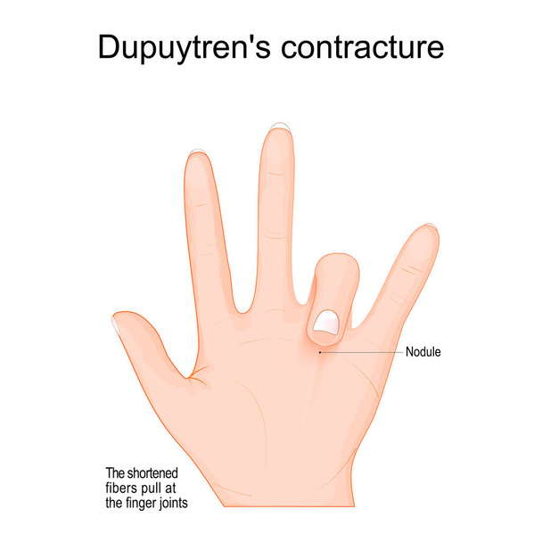 La contractura de Dupuytren. el dedo se dobla hacia la palma. Enfermedad de Dupuytren en la mano izquierda. trastorno fibroso que causa engrosamiento y acortamiento de la fascia palmar y conduce a contracturas digitales. Vector - Vector, imagen