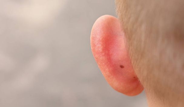 skin sunburnt of child ears from sun close up. back view. summer hot vacation. health and medical concept. - Photo, Image