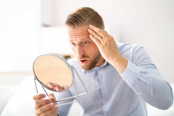Alopecia Man Hair Loss. Despair And Emotional Stress - Photo, image