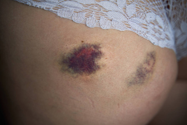Lesión en la piel después de una caída. Hematoma en la nalga de una mujer. - Foto, imagen