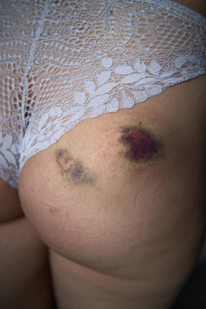 Close up of a hematoma on buttock after fall. A minor injury after sport activity appearing as a swollen area of discolored skin on the body - Photo, Image