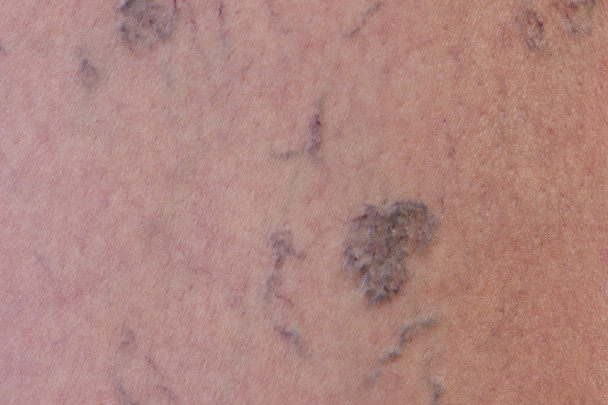 Close-up of varicose veins - Photo, Image