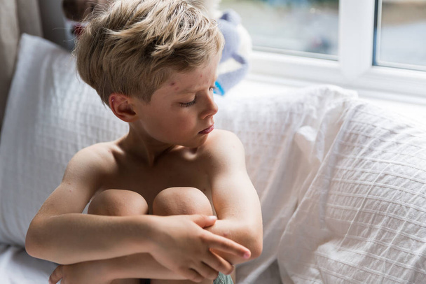 Toddler boy with chicken pox, sitting in bed with fever - Photo, Image