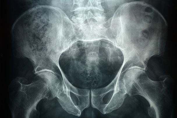 Pevich-röntgen
 - Valokuva, kuva