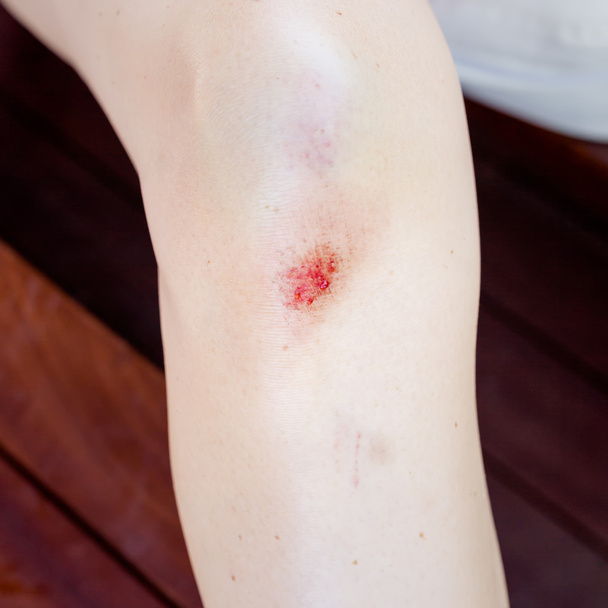 Rodilla femenina lesionada
 - Foto, imagen