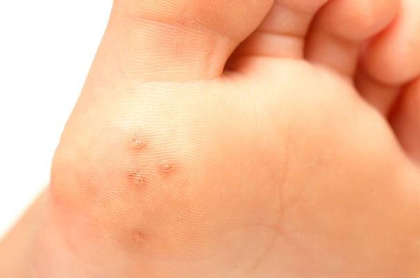 Closeup of plantar warts under foot of a child caused by human papillomavirus (HPV) - 写真・画像