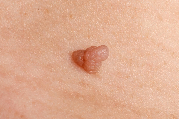 cancer papilloma on the skin, wart close up. - Foto, afbeelding