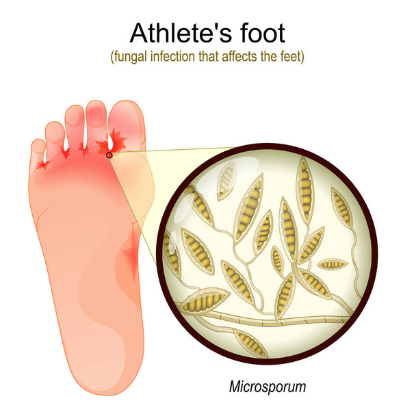 Athlete's foot. fungal infection that affects the feet. Close-up of yeast that causes infection disease of skin. Microsporum. vector illustration - Vector, Image