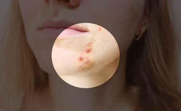 Pelle grassa della donna con problemi di acne. Cicatrici e ferite sul viso. Foto di assistenza sanitaria. - Foto, immagini