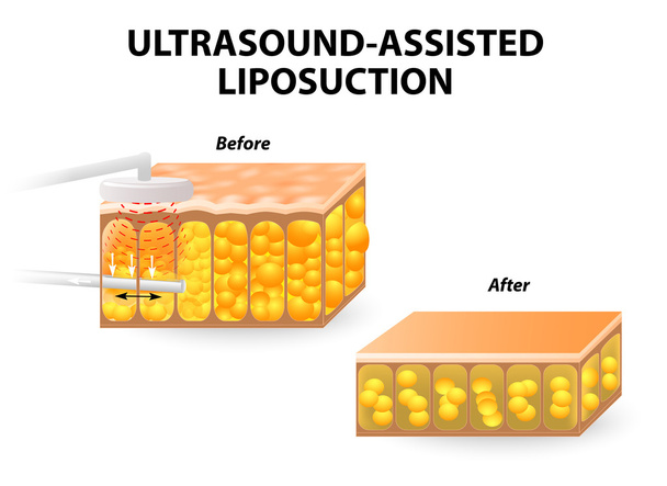 Liposucción asistida por ultrasonido
 - Vector, imagen