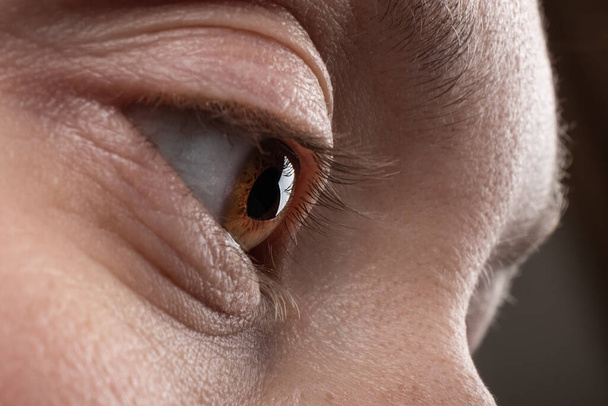 keratoconus disease of the cornea of the eye macro, fatigue corneal thinning. - 写真・画像
