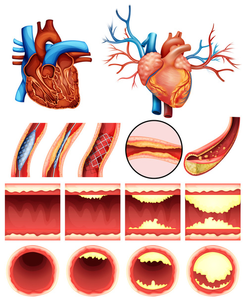 Colesterolo cardiaco
 - Vettoriali, immagini