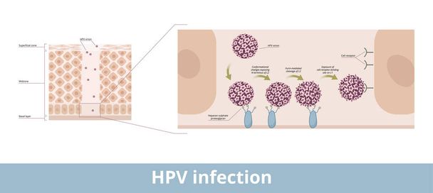 HPV enfeksiyonu. Papillomaviridae familyasından gelen bir DNA virüsünün insan papillomavirüs enfeksiyonunun işleme tabi tutulması ve hücre reseptörünün bağlanma aşamaları. - Vektör, Görsel