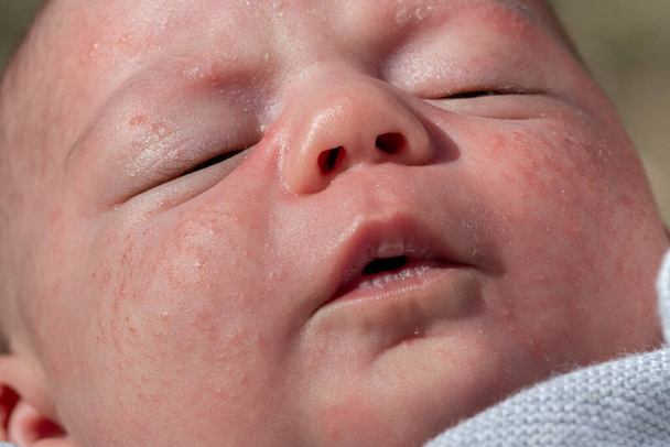 Porträt eines neugeborenen Babys mit roten Wangen mit kleinen Pickeln, kindlicher Akne, Dickmacherei, Milia. Verletzungen im Gesicht des Babys in den ersten Monaten. Neurodermitis. Neugeborenes Babygesicht und - Foto, Bild