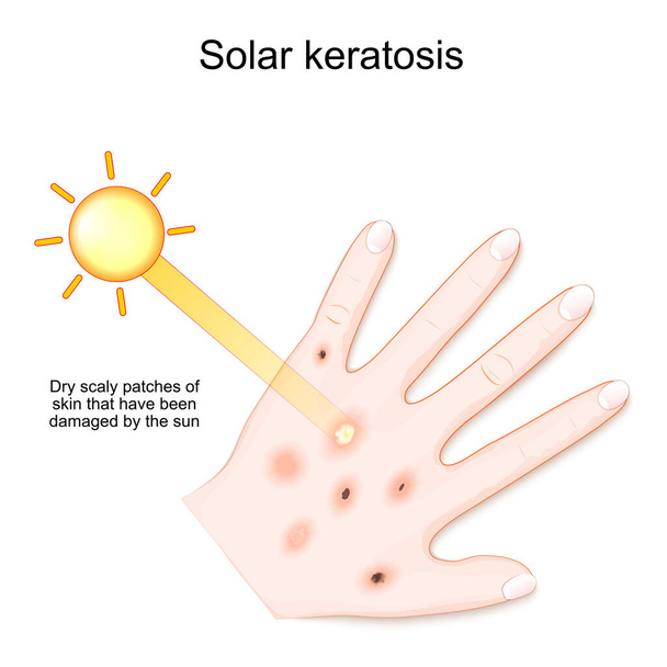 Solární keratóza. Suché šupinaté skvrny kůže, které byly poškozeny sluncem. Lidská dlaň s vyrážkou po slunci. vektorová ilustrace - Vektor, obrázek