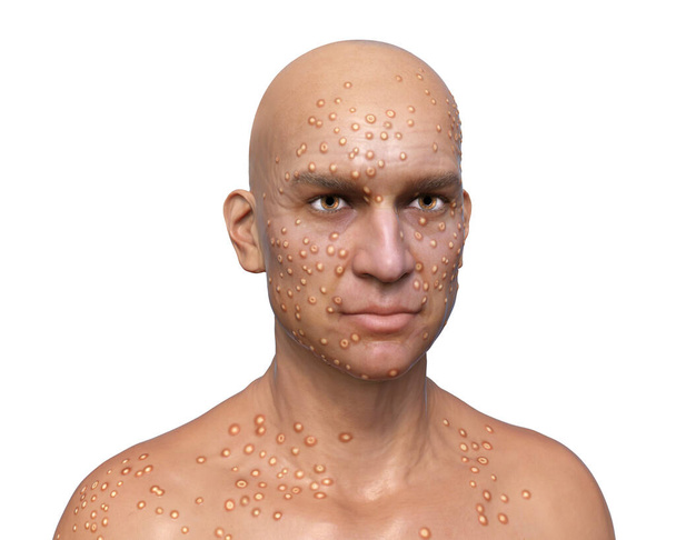 Ένας άνθρωπος με βράζει το δέρμα που προκαλείται από τον ιό της ευλογιάς, 3D εικονογράφηση. Λοιμώξεις από ευλογιά, ευλογιά μαϊμούδων και άλλους ιούς - Φωτογραφία, εικόνα