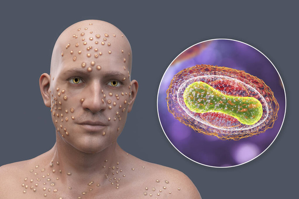 A man with skin boils caused by pox viruses and close-up view of the virus, 3D illustration. Smallpox, monkeypox and other pox virus infections - Foto, Imagen