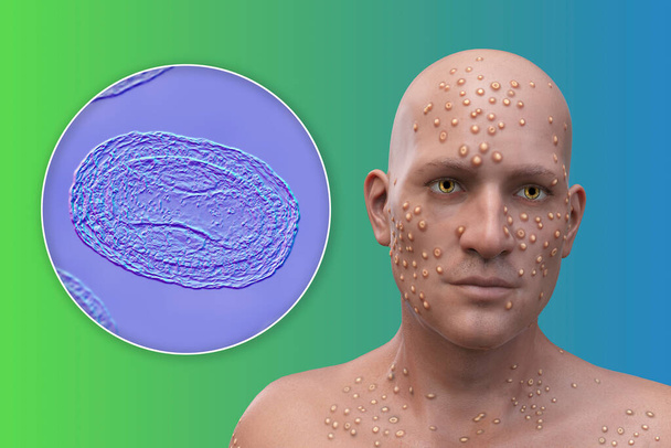Un homme avec des furoncles cutanés causés par des virus de la variole et vue rapprochée du virus, illustration 3D. Variole, variole du singe et autres infections à virus de la variole - Photo, image