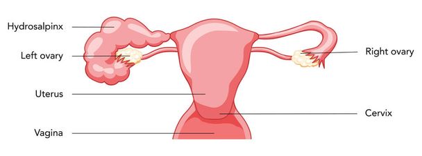 Hydrosalpinx Vrouwelijk voortplantingssysteem geblokkeerd eileiders baarmoeder met beschrijving tekst. Menselijke anatomie interne organen vector medische illustratie platte stijl pictogram geïsoleerd op witte achtergrond - Vector, afbeelding