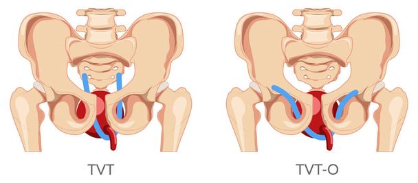 Set of Urinary incontinence tension free vaginal tape TVT versus transobturator tape TOT for female stress urinary incontinence therapy Female system is skeleton pelvis. Human anatomy flat icon - Vector, Image