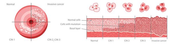 Set van baarmoederhalskanker Dysplasie stadia infografische vrouwelijke voortplantingssysteem Carcinoom cellen uterus. Vooraanzicht in een snede. Menselijke anatomie interne organen locatie regeling platte stijl pictogram - Vector, afbeelding