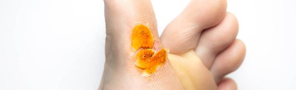Μεταδοτική ασθένεια του δέρματος με τα πόδια. Φωτογραφία ιατρικής θεραπείας - Φωτογραφία, εικόνα