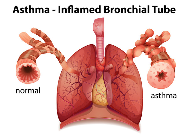 Бронхиальная астма
 - Вектор,изображение