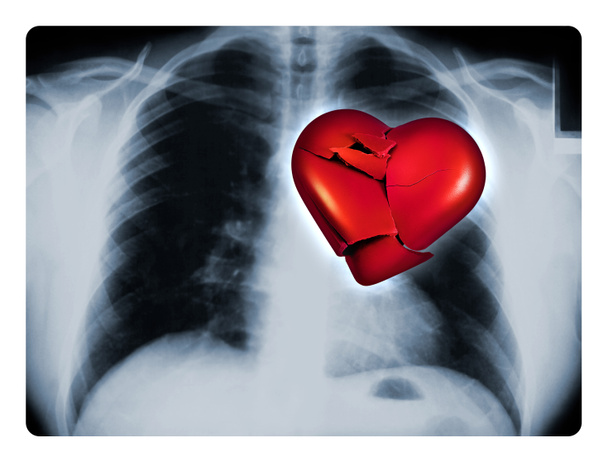 kırık kalp röntgen - Fotoğraf, Görsel