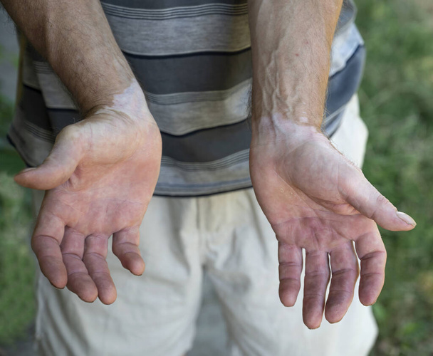 Symptomen van vitiligo op de huid op de handen van een man - Foto, afbeelding