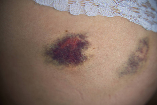 Detailní záběr hematomu na hýždi po pádu. Drobné zranění po sportovní aktivitě objevující se jako oteklá oblast zbarvené kůže na těle - Fotografie, Obrázek