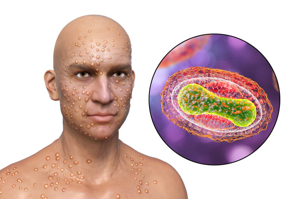 A man with skin boils caused by pox viruses and close-up view of the virus, 3D illustration. Smallpox, monkeypox and other pox virus infections - Foto, imagen