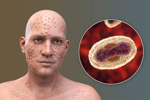 Un homme avec des furoncles cutanés causés par des virus de la variole et vue rapprochée du virus, illustration 3D. Variole, variole du singe et autres infections à virus de la variole - Photo, image