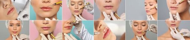 Collage with photos of woman during lip augmentation procedure. Banner design - Foto, imagen