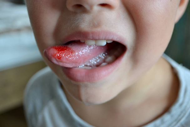 Childs ugryzł język. Zbliżenie ust, języka, wypukłość krwi - Zdjęcie, obraz
