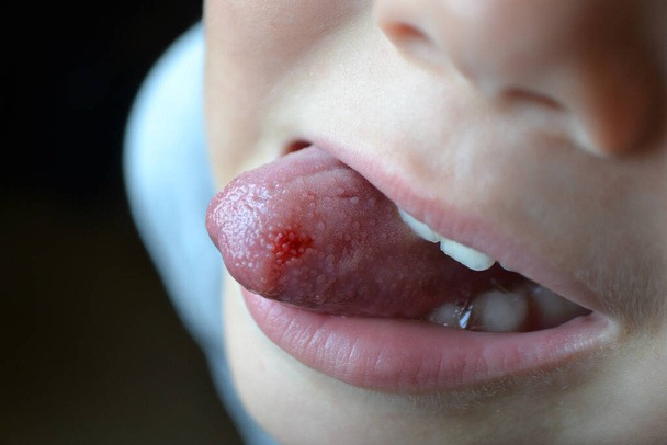 Childs bitten tongue. Close-up of lips, tongue, protrusion of blood - Zdjęcie, obraz