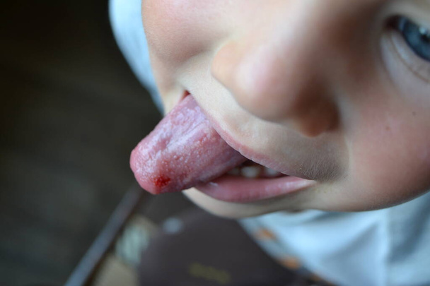 Childs bitten tongue. Close-up of lips, tongue, protrusion of blood - Foto, imagen