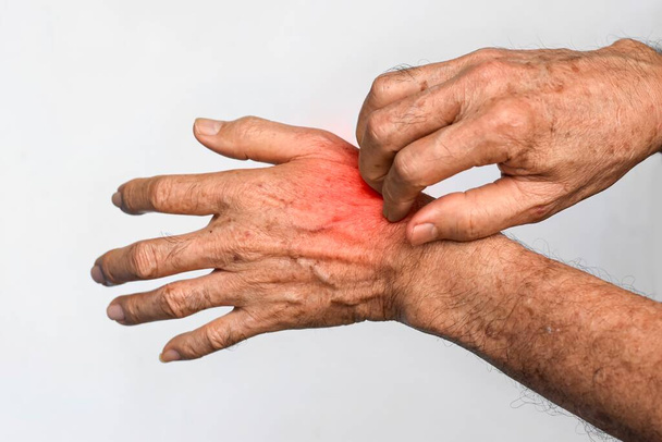 Asian elder man scratching his hand. Concept of itchy skin diseases such as scabies, fungal infection, eczema, psoriasis, allergy, etc. - Φωτογραφία, εικόνα