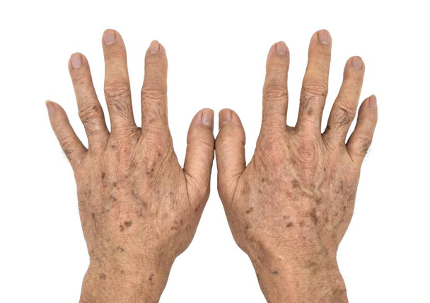 Leeftijd vlekken op handen van Aziatische oudere man. Ze zijn bruin, grijs, of zwarte vlekken en ook wel levervlekken, seniele lentigo, zonne-lentigines, of zonnevlekken. - Foto, afbeelding