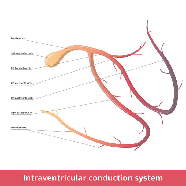 Sydänkammionsisäinen johtumisjärjestelmä. Sydämen intraventrikulaarinen (sähköinen) johtumisjärjestelmä lähettää sinus solmun tuottamia signaaleja, jotka aiheuttavat lihasten supistumista: atrioventrikulaarinen solmu, Purkinjen kuidut, Hänen nippu - Vektori, kuva