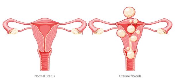 Conjunto de fibromas uterinos Leiomiomas femeninos útero del sistema reproductivo normal y con dolor de enfermedad. Anatomía humana ilustración médica esquema de ubicación de órganos internos aislados, icono de estilo plano del cuello uterino - Vector, Imagen