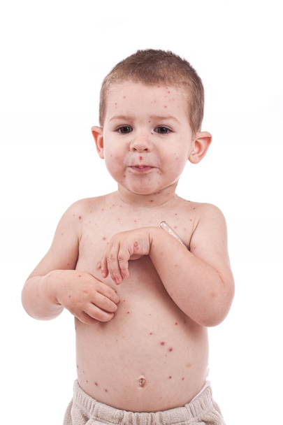 Little boy whit smallpox - Photo, Image
