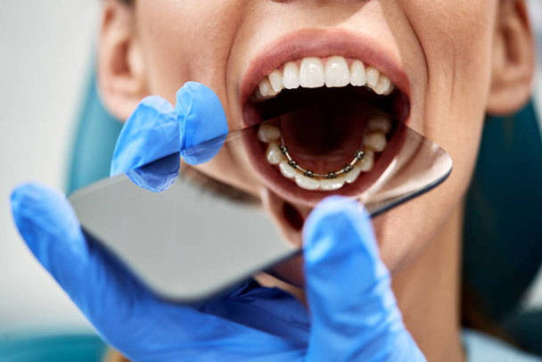 Close-up of orthodontist checking lingual braces of female patient with a mirror during appointment at dentist's office. - Φωτογραφία, εικόνα
