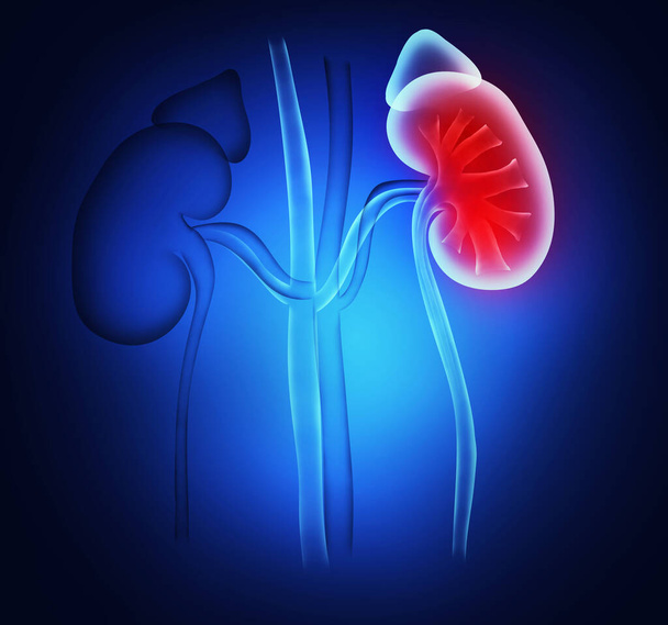 Illustration of healthy and inflamed kidneys on blue background - 写真・画像