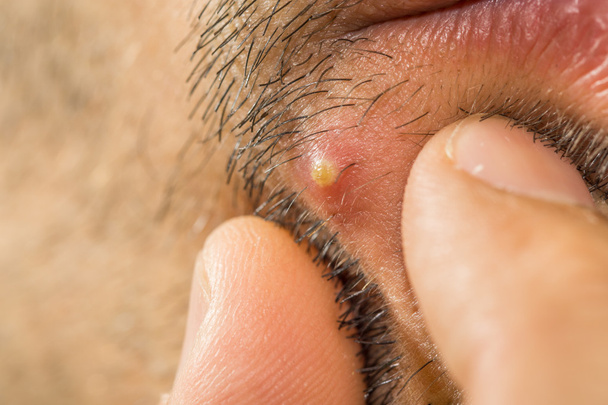 Extreme closeup of caucasian man with stub squeezing a pimple - Photo, Image