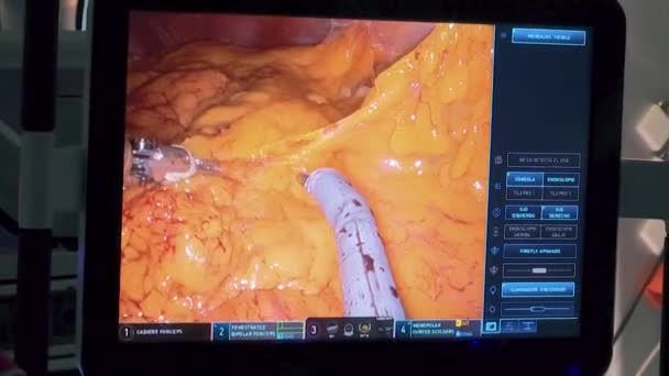 MONITORING ARMS FROM SURGERY MACHINE OPERATING ADIPOSE TISSUE WITHIN HUMAN BODY - Felvétel, videó