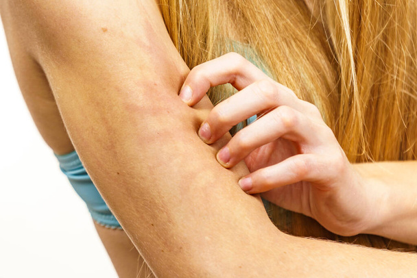 Itchy skin, dermatitis, food allergies. Woman having itching, scratching her arm with allergy rash. - 写真・画像